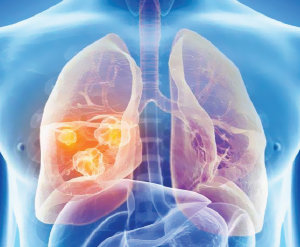 Respiratory infections