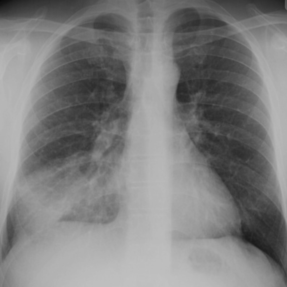 Respiratory Infections