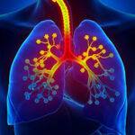 Bronchial-Asthma-Dubai